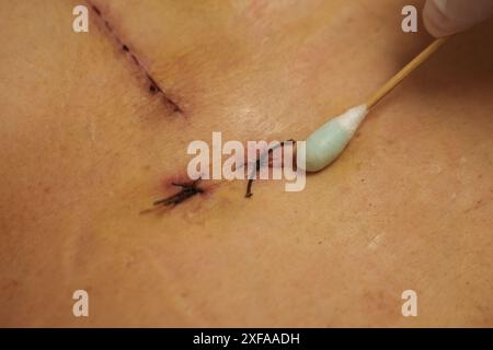 Medico che utilizza alcool e cotone bud pulizia ferita da chirurgia a cuore aperto sul corpo femminile (rigurgito della valvola cardiaca) Foto Stock