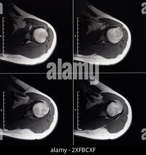 Immagine MRI dell'articolazione della spalla dopo una frattura e una lussazione. Impressione di frattura della testa dell'omero. Danno alla capsula articolare, deformattazione articolare Foto Stock