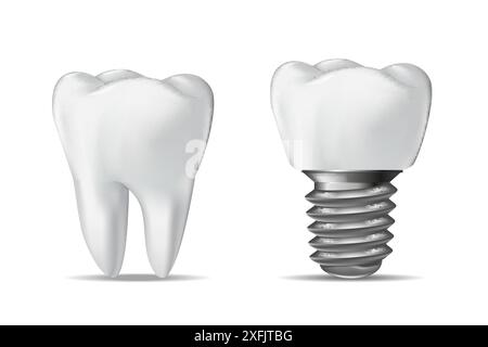 Dente umano e impianto dentale, concetto dentale, illustrazione vettoriale realistica, su sfondo bianco Illustrazione Vettoriale