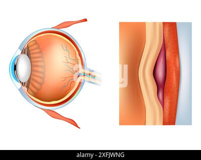 Degenerazione maculare, nota anche come degenerazione maculare correlata all'età. AMD o ARMD. Danni alla macula Illustrazione Vettoriale