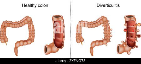 Diverticolite. Sezione trasversale di un colon con sanguinamento e infiammazione di sacchetti o diverticoli anomali. Confronto e differenza tra una salute Illustrazione Vettoriale