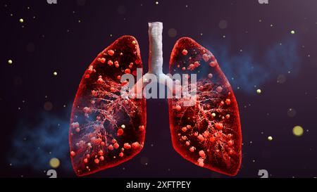 La mano del medico polmoni infetti concetto, tubercolosi presenza di infezione da micobatterio, tubercolosi batterica, cancro polmonare e malattia polmonare Foto Stock