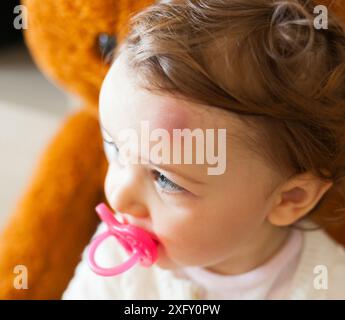 Bambino con grande livido sul suo fronte dopo urti. I bambini spesso accidentalmente urtare le loro teste. Foto Stock