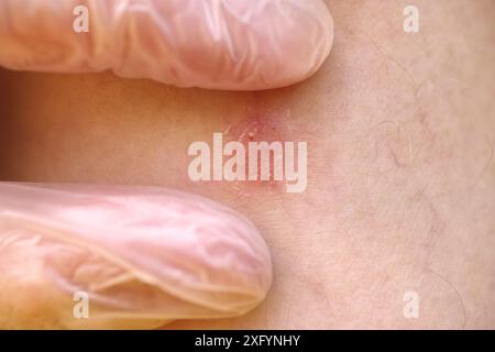 Un dermatologo che esamina una placca psoriasi sulla gamba di un paziente. Primo piano. Foto Stock