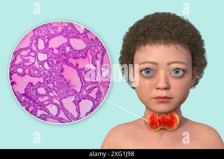 Illustrazione di un bambino con malattia di Graves e un primo piano del tessuto tiroideo interessato. La malattia di Graves può causare un ingrossamento della ghiandola tiroidea (gozzo, base del collo) a svilupparsi, e può causare un'eccessiva sporgenza degli occhi (esoftalmo). La malattia di Graves è una condizione autoimmune in cui vengono prodotti anticorpi che causano alla ghiandola tiroidea di produrre ormoni eccessivi. Foto Stock