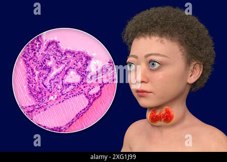 Illustrazione di un bambino con malattia di Graves e un primo piano del tessuto tiroideo interessato. La malattia di Graves può causare un ingrossamento della ghiandola tiroidea (gozzo, base del collo) a svilupparsi, e può causare un'eccessiva sporgenza degli occhi (esoftalmo). La malattia di Graves è una condizione autoimmune in cui vengono prodotti anticorpi che causano alla ghiandola tiroidea di produrre ormoni eccessivi. Foto Stock