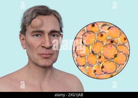 Illustrazione di un uomo con un lipoma sulla fronte e vista ravvicinata degli adipociti (cellule adipose) che compongono il lipoma. I lipomi sono benigni (non cancerosi) e in genere non richiedono un trattamento. Foto Stock