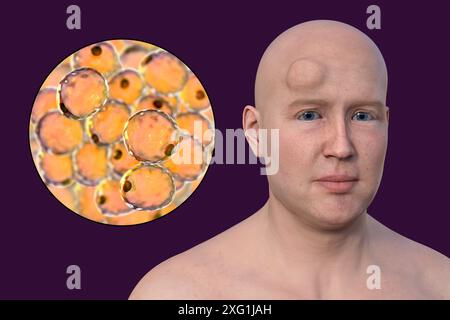 Illustrazione di un uomo con un lipoma sulla fronte e vista ravvicinata degli adipociti (cellule adipose) che compongono il lipoma. I lipomi sono benigni (non cancerosi) e in genere non richiedono un trattamento. Foto Stock