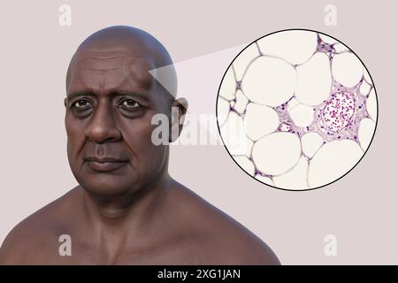 Illustrazione di un uomo con un lipoma sulla fronte e vista ravvicinata degli adipociti (cellule adipose) che compongono il lipoma. I lipomi sono benigni (non cancerosi) e in genere non richiedono un trattamento. Foto Stock