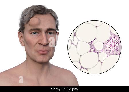 Illustrazione di un uomo con un lipoma sulla fronte e vista ravvicinata degli adipociti (cellule adipose) che compongono il lipoma. I lipomi sono benigni (non cancerosi) e in genere non richiedono un trattamento. Foto Stock