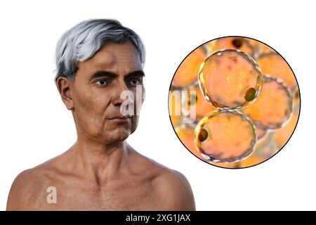 Illustrazione di un uomo con un lipoma sulla fronte e vista ravvicinata degli adipociti (cellule adipose) che compongono il lipoma. I lipomi sono benigni (non cancerosi) e in genere non richiedono un trattamento. Foto Stock