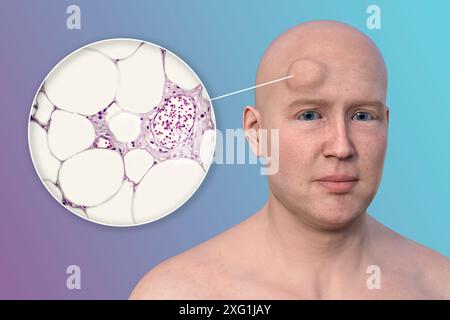 Illustrazione di un uomo con un lipoma sulla fronte e vista ravvicinata degli adipociti (cellule adipose) che compongono il lipoma. I lipomi sono benigni (non cancerosi) e in genere non richiedono un trattamento. Foto Stock