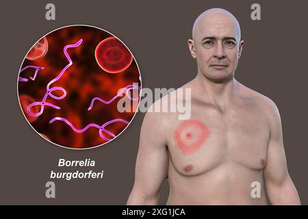 Illustrazione che mostra eritema migrante, una caratteristica eruzione cutanea osservata in pazienti con malattia di Lyme, e un primo piano dei batteri Borrelia burgdorferi causali. Questo batterio viene solitamente trasferito all'uomo tramite un vettore di insetti, come una zecca. Foto Stock