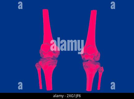 Tomografia computerizzata colorata (CT) scansione di ginocchia sane. Foto Stock