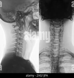 Radiografia della regione cervicale (collo) della colonna vertebrale di una persona sana. Foto Stock