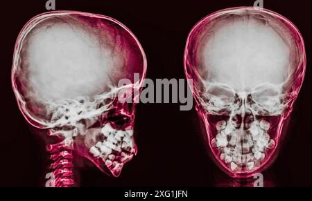 Raggi X colorati di un cranio sano, da una vista anteriore (anteriore) e laterale (laterale). Foto Stock