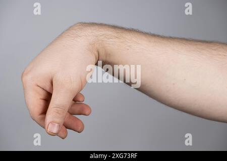 Cisti del ganglio o igroma del polso sulla mano di un paziente di sesso maschile. Foto Stock