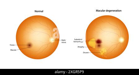 Retina normale e degenerazione maculare Drusen, atrofia, emorragia subretinica. Illustrazione Vettoriale