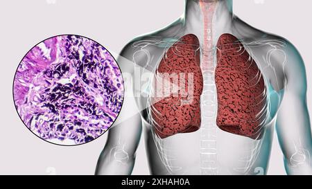 Illustrazione dei polmoni influenzati dal fumo insieme a un'immagine micrografica. Foto Stock