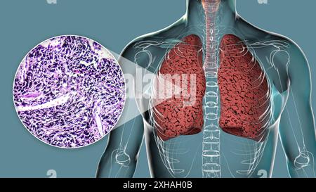 Illustrazione dei polmoni influenzati dal fumo insieme a un'immagine micrografica. Foto Stock