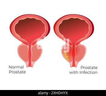 Prostata normale e ghiandola prostatica con infezione - illustrazione di scorta come file EPS 10 Illustrazione Vettoriale