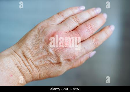 la mano si gonfia dalla puntura della vespa Foto Stock