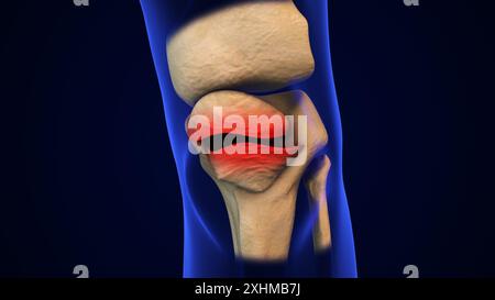 Concetto medico di Patella Bone rotto Foto Stock