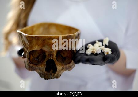 il fascio di denti umani estratti indesiderati decadono. Denti umani nelle mani Foto Stock