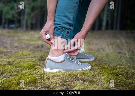 L'uomo con zanzare morde prurito alle gambe, applicando il balsamo sulla pelle gonfiata, soffrendo di reazione allergica Foto Stock