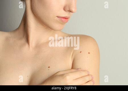 Donna con talpe sulla pelle su sfondo grigio chiaro, primo piano Foto Stock