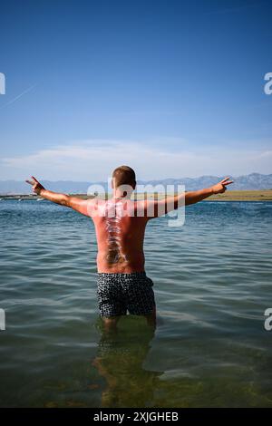 Uomo con scottature sulla schiena, in piedi in acqua, con la parola estate scritta sulla crema solare. Foto Stock