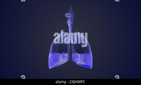 L'effusione pleurica rappresenta uno smaltimento inadeguato Foto Stock