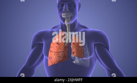 Concetto medico della malattia dello pneumotorace polmonare Foto Stock