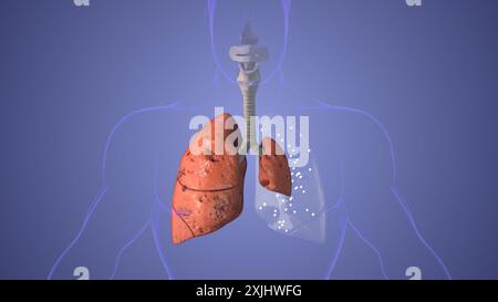 Concetto medico della malattia dello pneumotorace polmonare Foto Stock