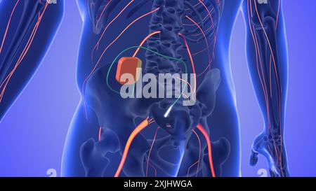 Concetto medico di stimolazione del nervo sacrale Foto Stock