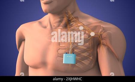 Terapia di stimolazione dei nervi periferici nell'area della spalla Foto Stock