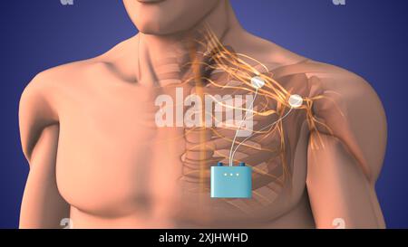 Terapia di stimolazione dei nervi periferici nell'area della spalla Foto Stock