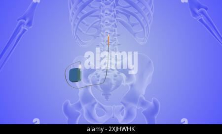 La nozione medica di stimolazione del midollo spinale Foto Stock