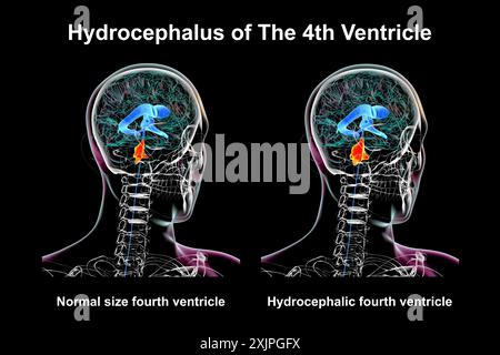 Illustrazione che raffigura un ingrandimento isolato del quarto ventricolo cerebrale (destro) rispetto al quarto ventricolo di dimensioni normali (sinistro). Foto Stock
