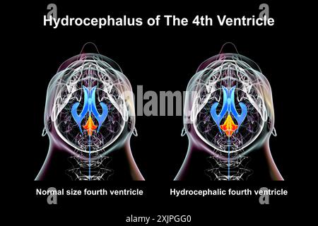 Immagine che raffigura l'ingrandimento isolato del quarto ventricolo cerebrale (destro) rispetto al quarto ventricolo di dimensioni normali (sinistro), vista inferiore. Foto Stock