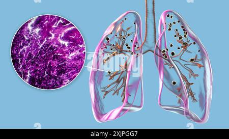 Illustrazione che raffigura i polmoni colpiti dalla silicosi, rivelando noduli silicotici scuri, insieme a un'immagine micrografica dei polmoni interessati. Si tratta di una malattia polmonare a lungo termine causata dall'inalazione di grandi quantità di silice. Foto Stock