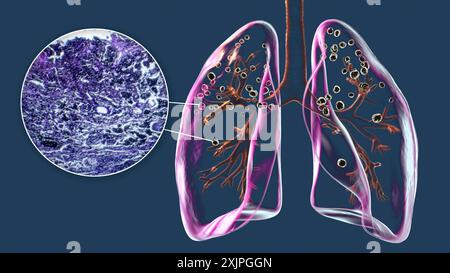 Illustrazione che raffigura i polmoni colpiti dalla silicosi, rivelando noduli silicotici scuri, insieme a un'immagine micrografica dei polmoni interessati. Si tratta di una malattia polmonare a lungo termine causata dall'inalazione di grandi quantità di silice. Foto Stock