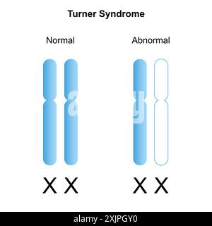 Sindrome di Turner, illustrazione. Foto Stock