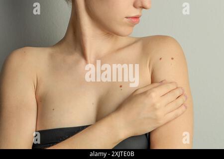 Donna con talpe sulla pelle su sfondo grigio chiaro, primo piano Foto Stock