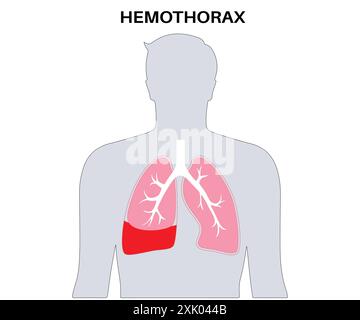 Illustrazione medica dell'emotorace - accumulo di sangue nel polmone, diagramma della malattia del sistema respiratorio Illustrazione Vettoriale