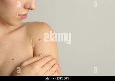 Donna con talpe sulla pelle su sfondo grigio chiaro, primo piano. Spazio per il testo Foto Stock