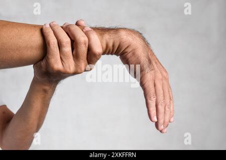 Lesione nervosa radiale o goccia di polso di uomo asiatico Myanmar. Foto Stock