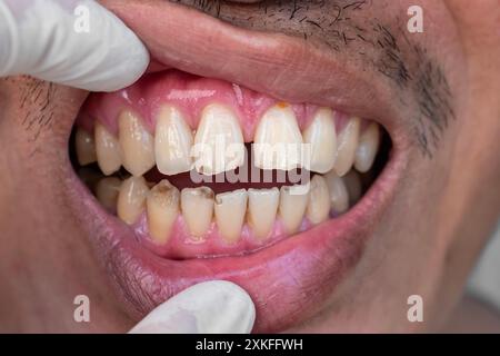 Enorme spazio tra i denti anteriori o gli incisori dell'uomo cinese asiatico. Diastema. Denti incrinati o scheggiati. Foto Stock