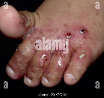 Infestazione di scabbia con infezione batterica secondaria o sovrapposta e pustole nel piede del bambino asiatico. Una condizione contagiosa della pelle causata da acari Foto Stock
