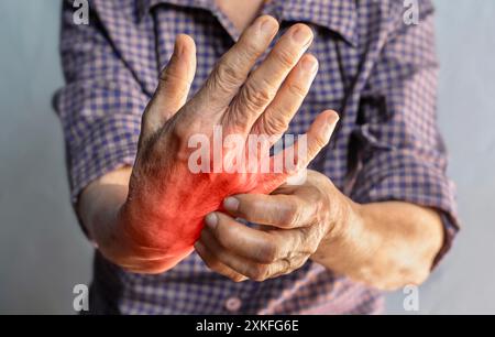 Donna anziana asiatica che graffia la mano. Concetto di malattie della pelle pruriginose come scabbia, infezione fungina, eczema, psoriasi, eruzione cutanea, allergia, ecc. Foto Stock